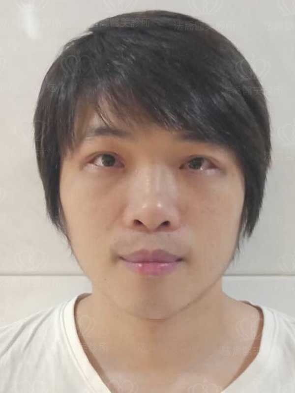 法喬醫美診所_割雙眼皮合併提眼瞼肌+開眼頭開眼尾案例