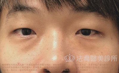 法喬醫美診所_割雙眼皮合併提眼瞼肌+開眼頭開眼尾案例