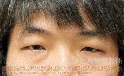 法喬醫美診所_男生_罐子_大眼術前案例