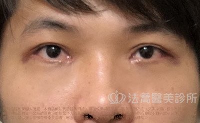 法喬醫美診所_割雙眼皮合併提眼瞼肌+開眼頭開眼尾案例