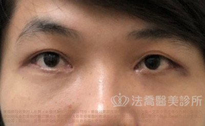 法喬醫美診所_男生_罐子_大眼術前案例