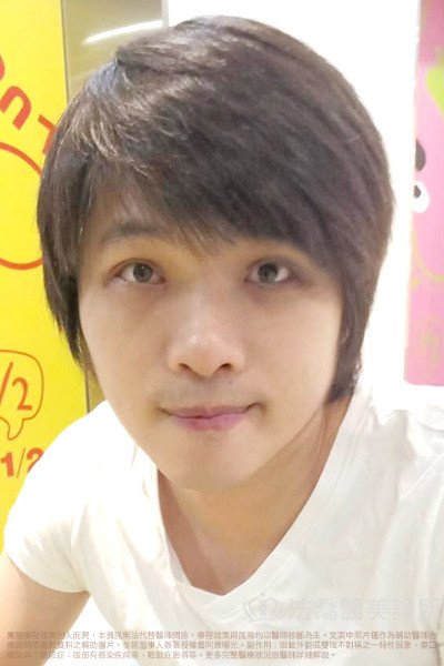 法喬醫美診所_割雙眼皮合併提眼瞼肌+開眼頭開眼尾案例