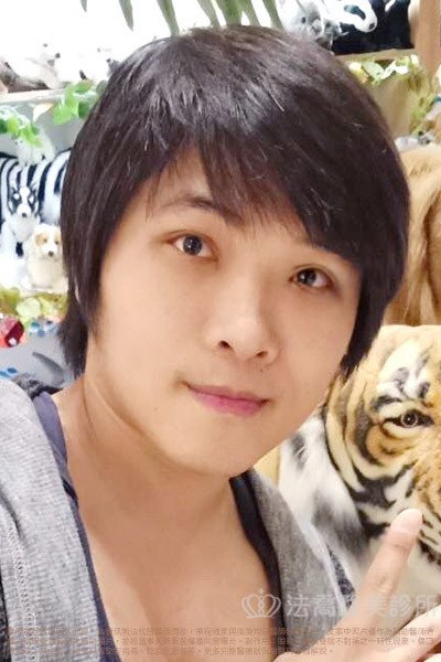 法喬醫美診所_割雙眼皮合併提眼瞼肌+開眼頭開眼尾案例