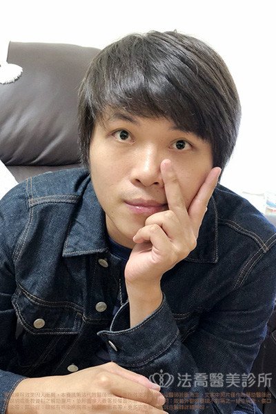 雙眼皮眼袋術後2個月案例