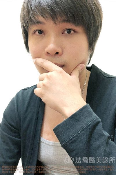 雙眼皮眼袋術後2個月案例