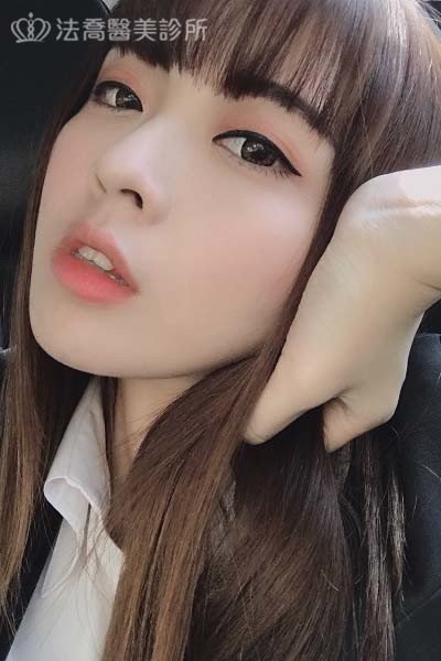 自體肋骨隆鼻