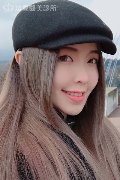 自體肋骨隆鼻