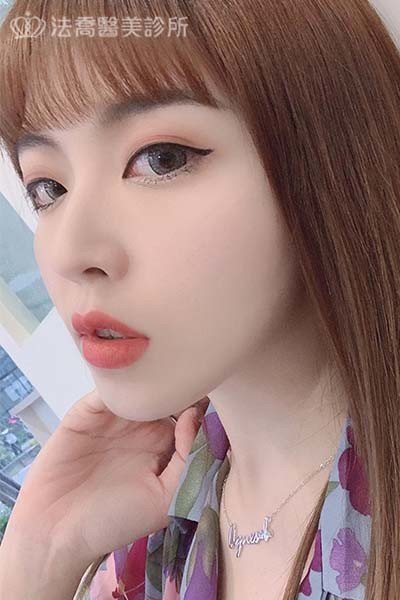 自體肋骨隆鼻