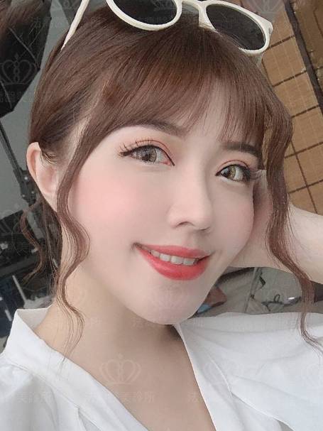 法喬醫美診所_蕭邦割雙眼皮合併提眼瞼肌+開眼頭開眼尾+眼尾下置_術後1個月