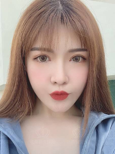 法喬醫美診所_蕭邦割雙眼皮合併提眼瞼肌+開眼頭開眼尾+眼尾下置_術後20天