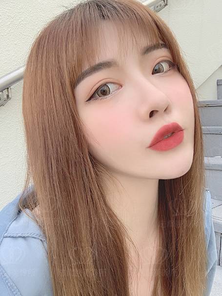 法喬醫美診所_蕭邦割雙眼皮合併提眼瞼肌+開眼頭開眼尾+眼尾下置_術後20天
