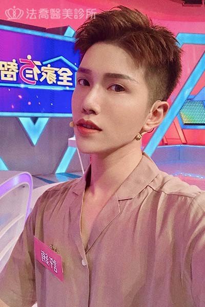 自體肋骨隆鼻