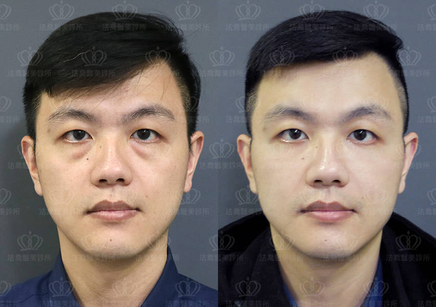 眼袋手術