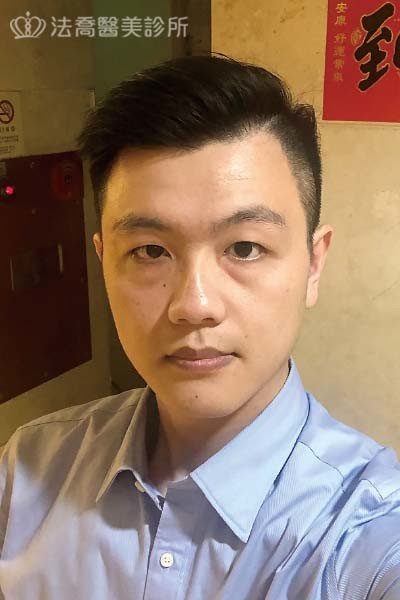 自體肋骨隆鼻
