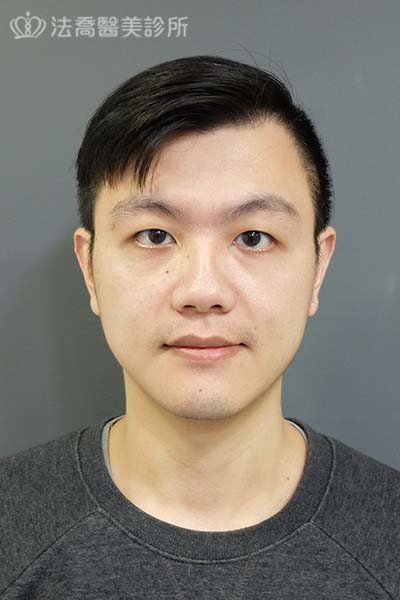 自體肋骨隆鼻