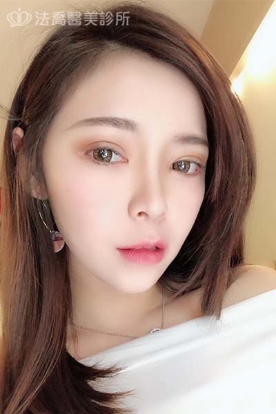 自體肋骨隆鼻