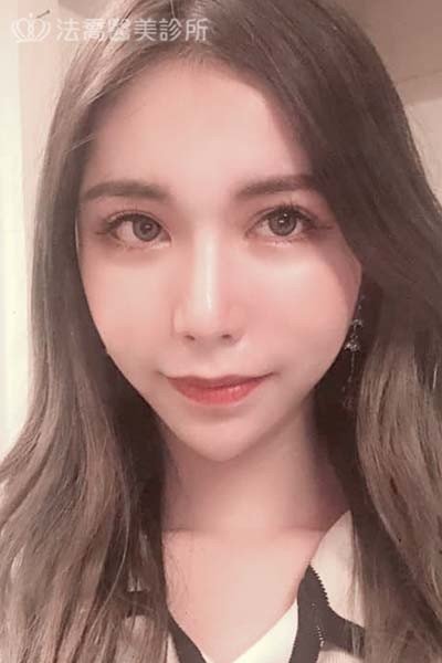 自體肋骨隆鼻