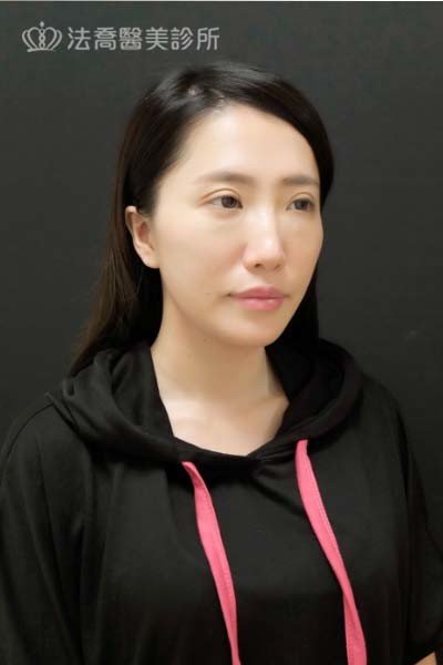 自體肋骨隆鼻