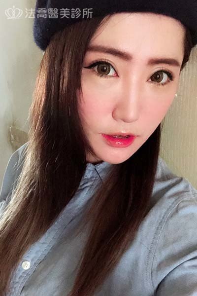 自體肋骨隆鼻