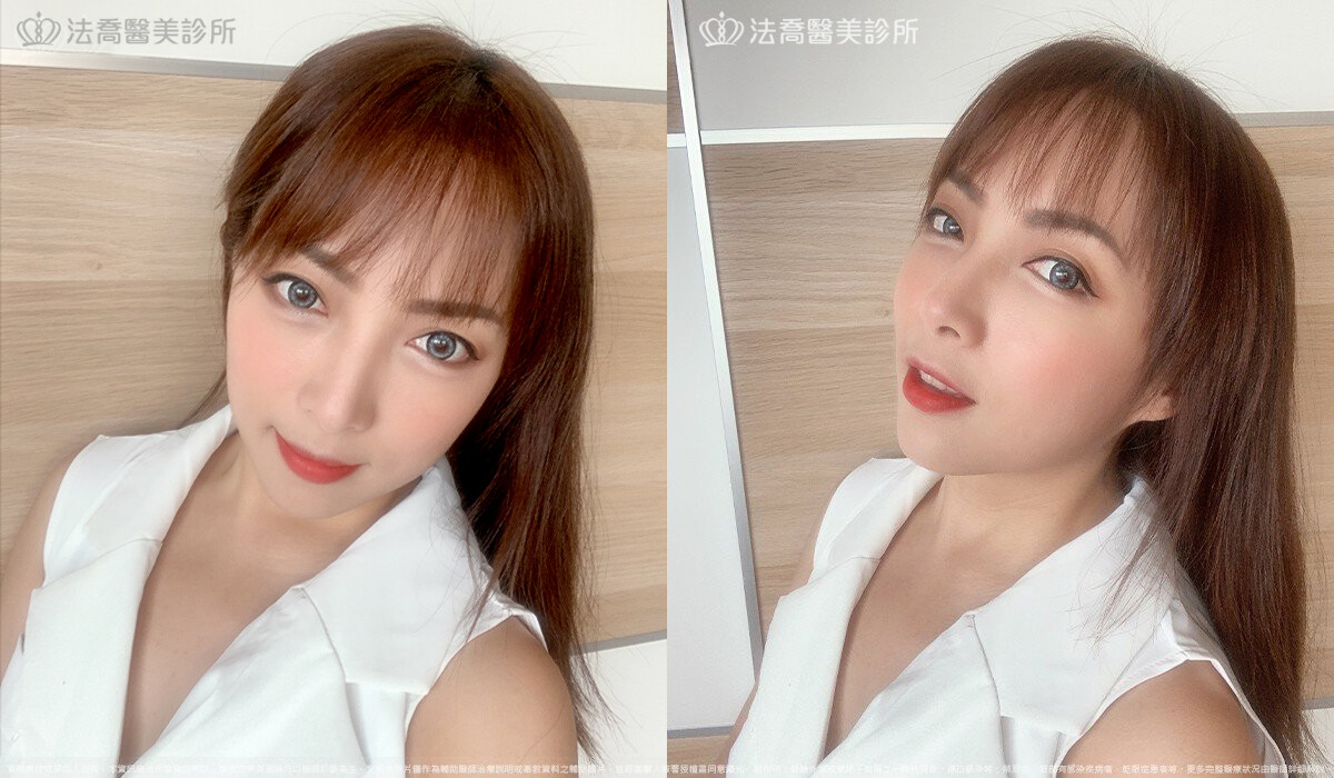 眼袋內開 脂肪移位 術後一個月 生活照