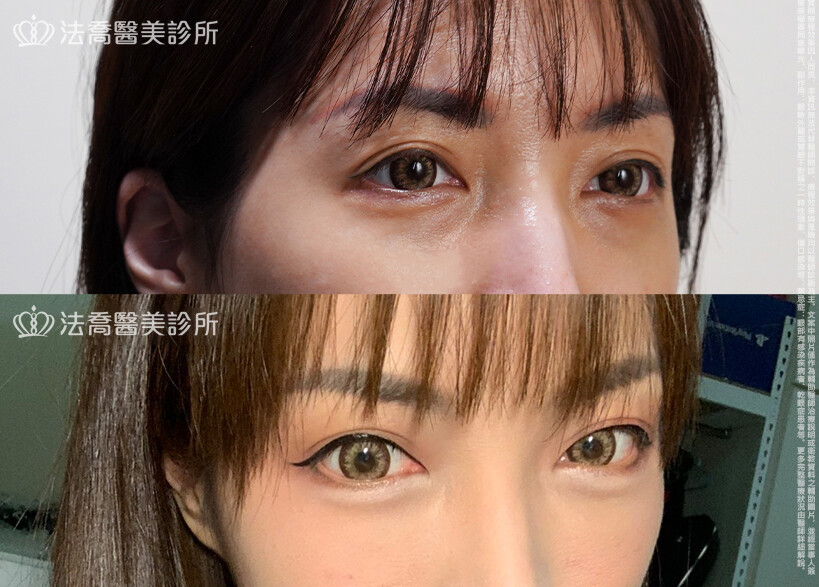 眼袋內開、脂肪移位 術前與術後1個月