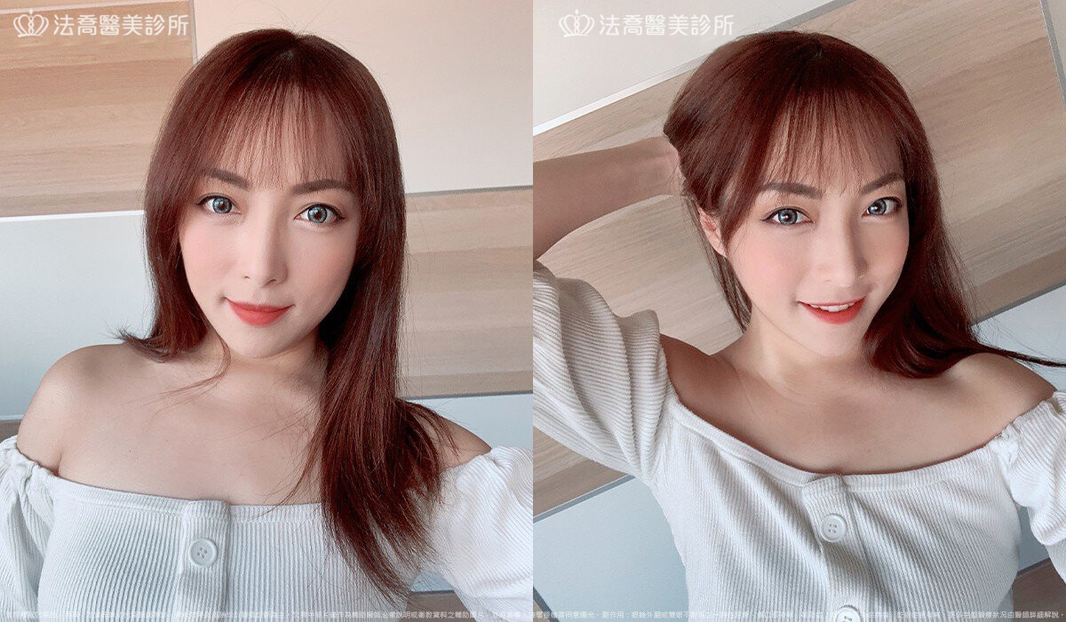 眼袋內開、脂肪移位 術後3個月