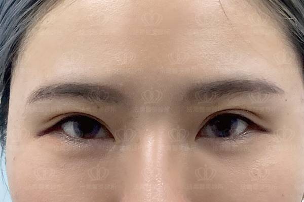 法喬醫美診所_蕭邦_割雙眼皮合併提眼瞼肌+開眼頭開眼尾+眼尾下置
