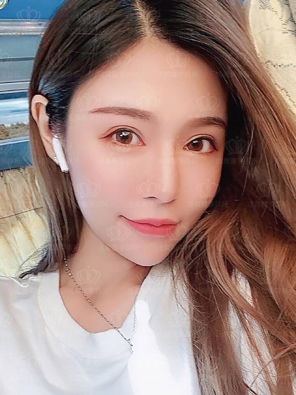 法喬醫美診所_割雙眼皮合併提眼瞼肌+開眼頭開眼尾+眼尾下置