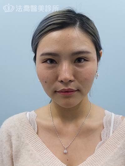 法喬醫美診所_割雙眼皮合併提眼瞼肌+開眼頭開眼尾+眼尾下置