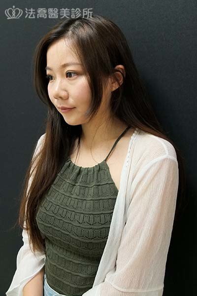 自體肋骨隆鼻