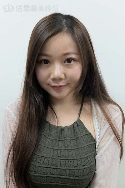自體肋骨隆鼻