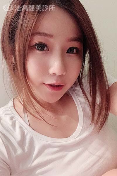 自體肋骨隆鼻