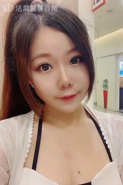 自體肋骨隆鼻