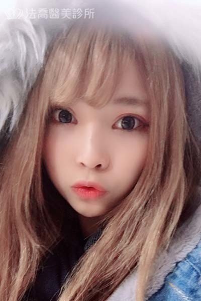 自體肋骨隆鼻