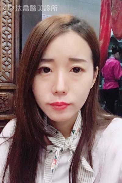 自體肋骨隆鼻