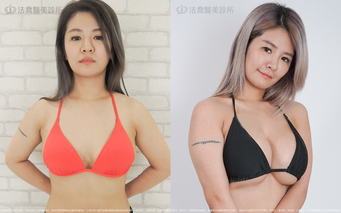 法喬醫美診所,邱浚彥,超音波複合式隆乳