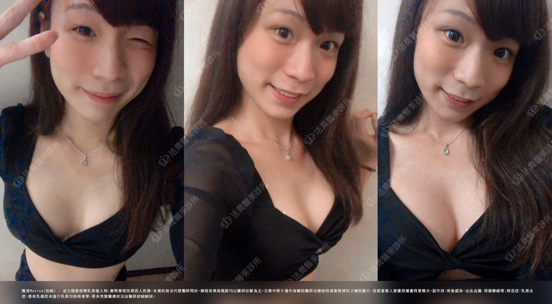 法喬醫美診所,邱浚彥,魔滴隆乳,自體脂肪豐胸