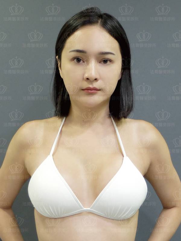 /files/images/案例分享/胸部【複合式隆乳】/林肯忠(林蕭)xd501_超音波複合式圓盤果凍矽膠隆乳/(術後3個月)(林蕭)xd501_超音波複合式圓盤果凍矽膠隆乳.jpg?1575545939