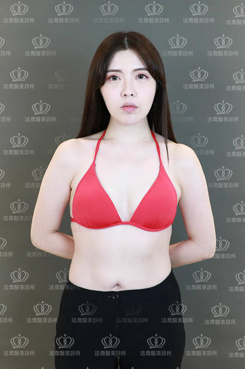 法喬醫美診所_魔滴複合式隆乳術前照
