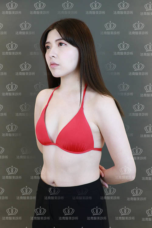 法喬醫美診所_魔滴複合式隆乳術前照