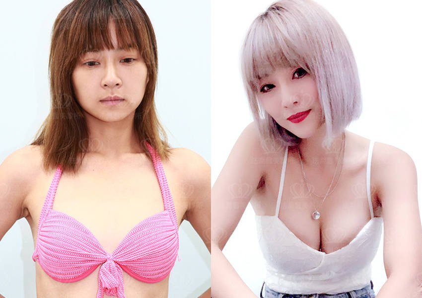 隆乳手術
