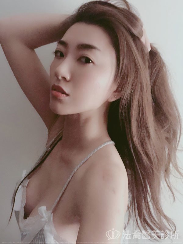 法喬醫美診所_複合式隆乳+威塑腹雕