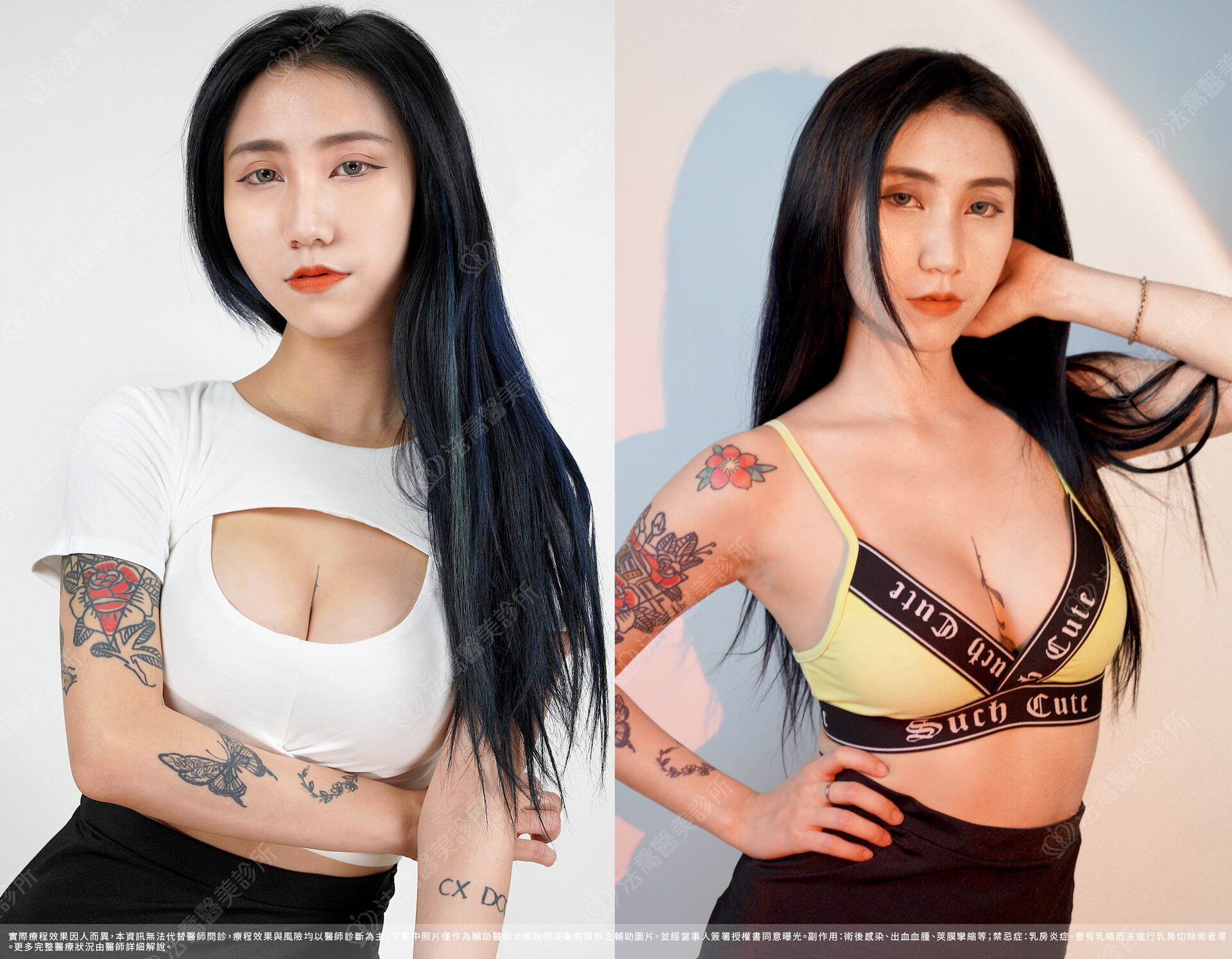 隆乳