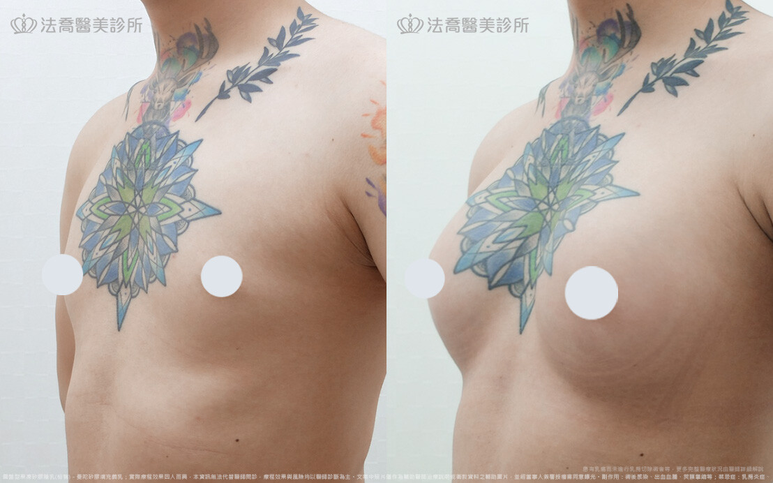 小淵隆乳術後5個月(右側)