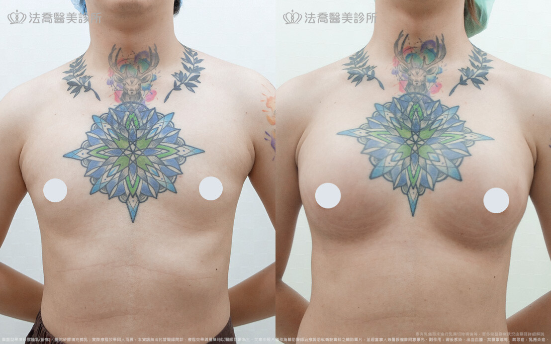 小淵隆乳術後5個月(正面)