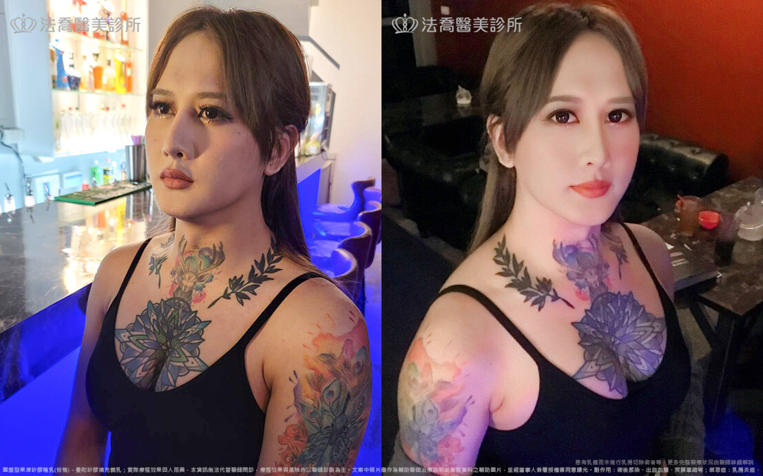 小淵隆乳手術 術後2個月生活照