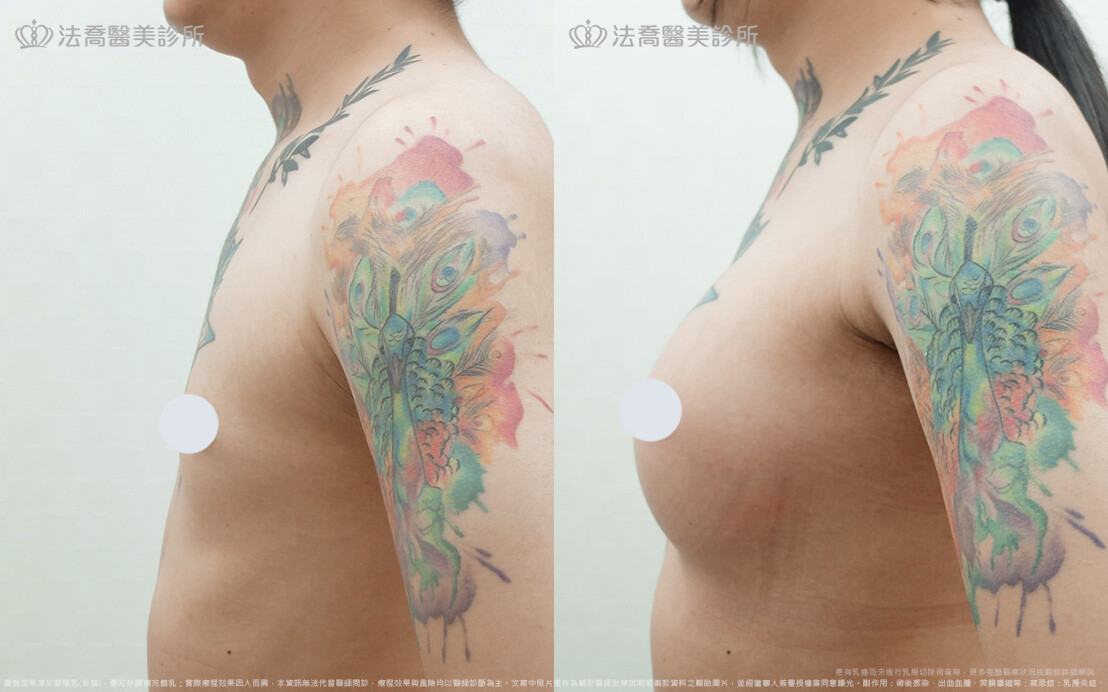 小淵隆乳術後1個月(右側90度)