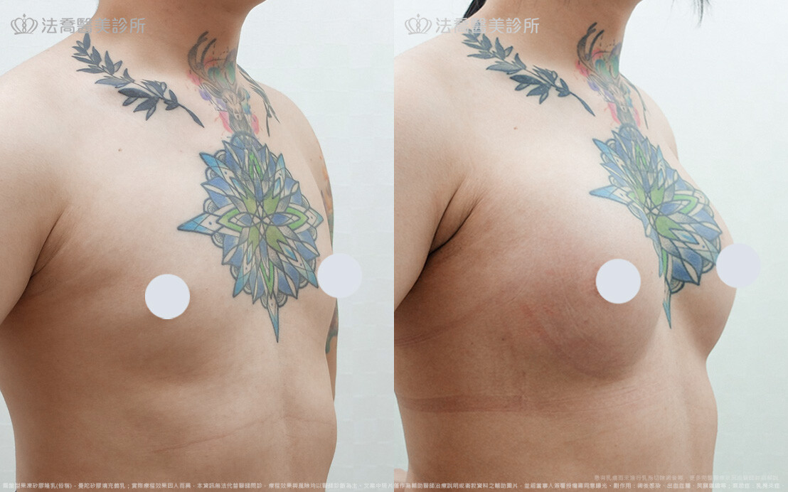 小淵隆乳術後1個月(左側)