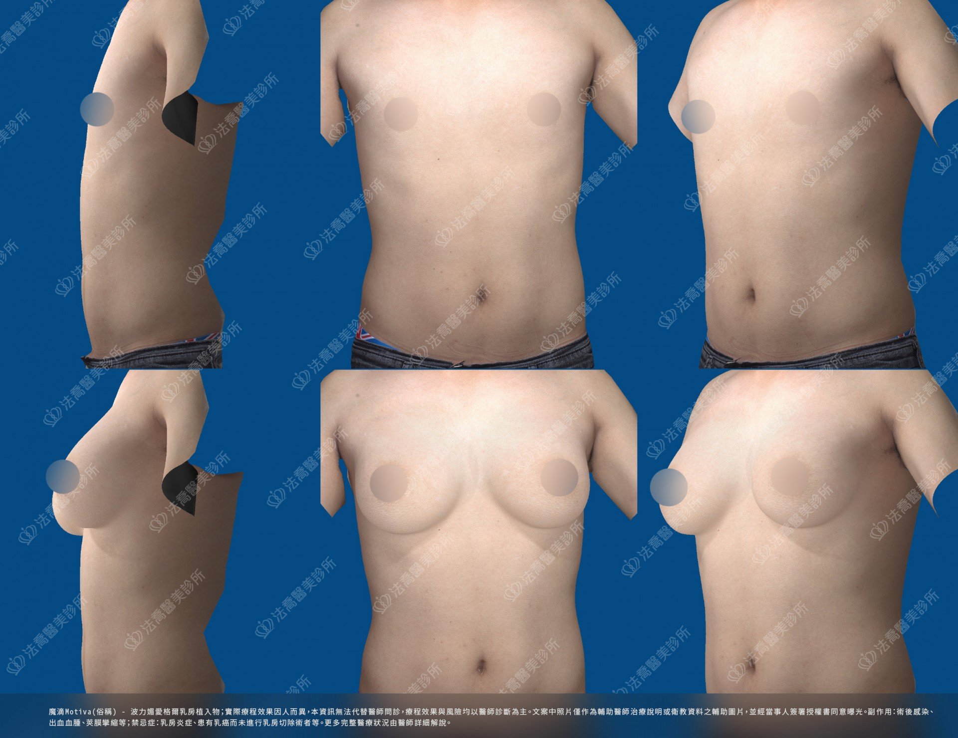 法喬醫美診所,邱浚彥,魔滴隆乳,隆乳推薦