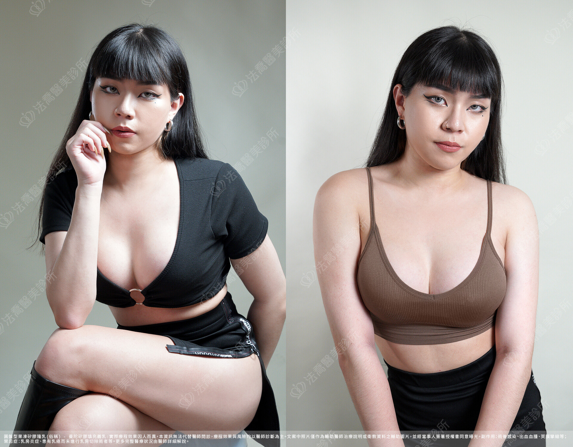 隆乳